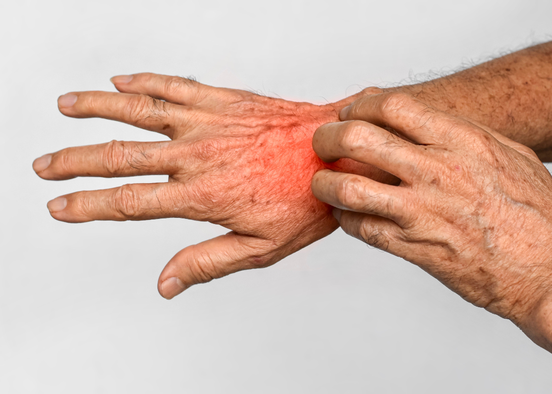 Ringworm & Scabies